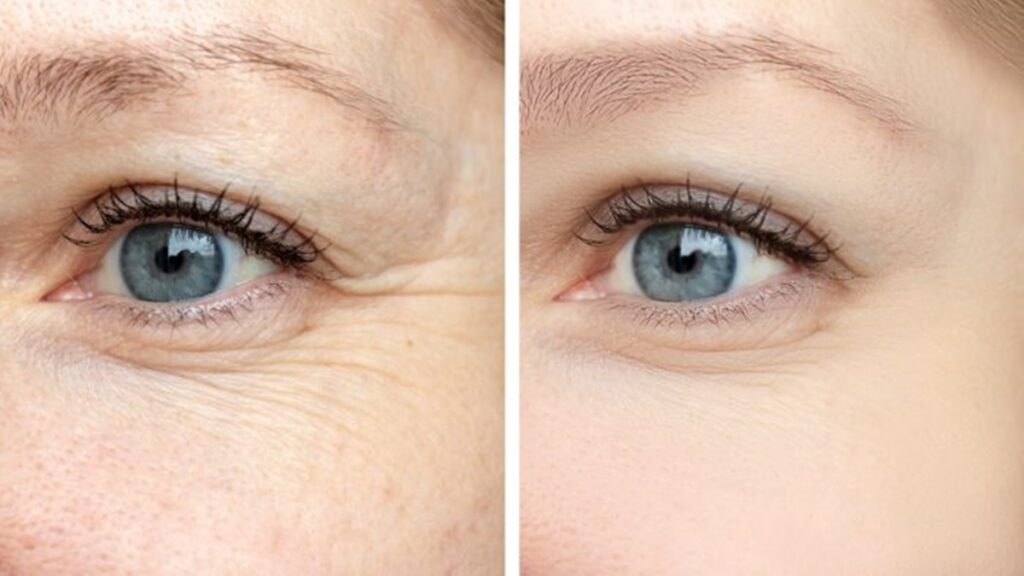 Are Facial Fillers helping with dark under-eye circles?