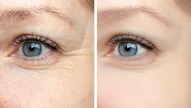 Photo of Are Facial Fillers Helping with Dark Under-eye Circles?