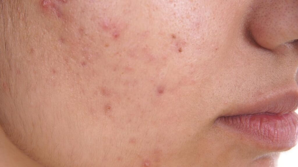 A Quick Guide to Understanding Acne Find The Best Dermatologist In Pune 02