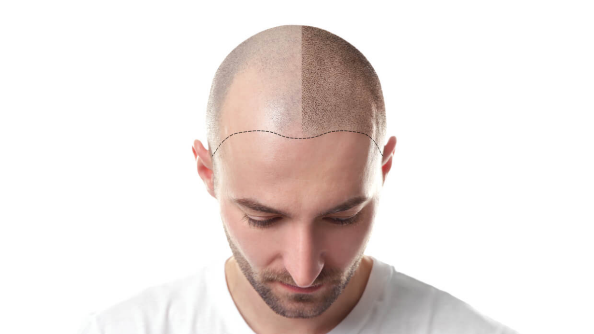 Crucial Things to Identify Before Going for Hair Transplant