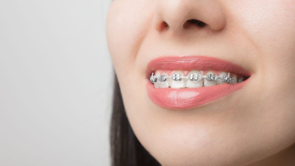 Impress clear aligners or traditional braces which is the better option?