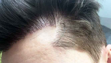 Photo of How a Hair Transplant Can Restore Your Confidence