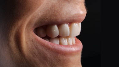 Photo of 7 Interesting Benefits of Opting for Dental Veneers