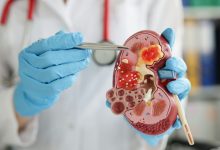 Photo of Driehaus Capital, Rock Springs Capital, and Armistice Capital Increase Positions in Travere’s Rare Kidney Disease Therapeutics