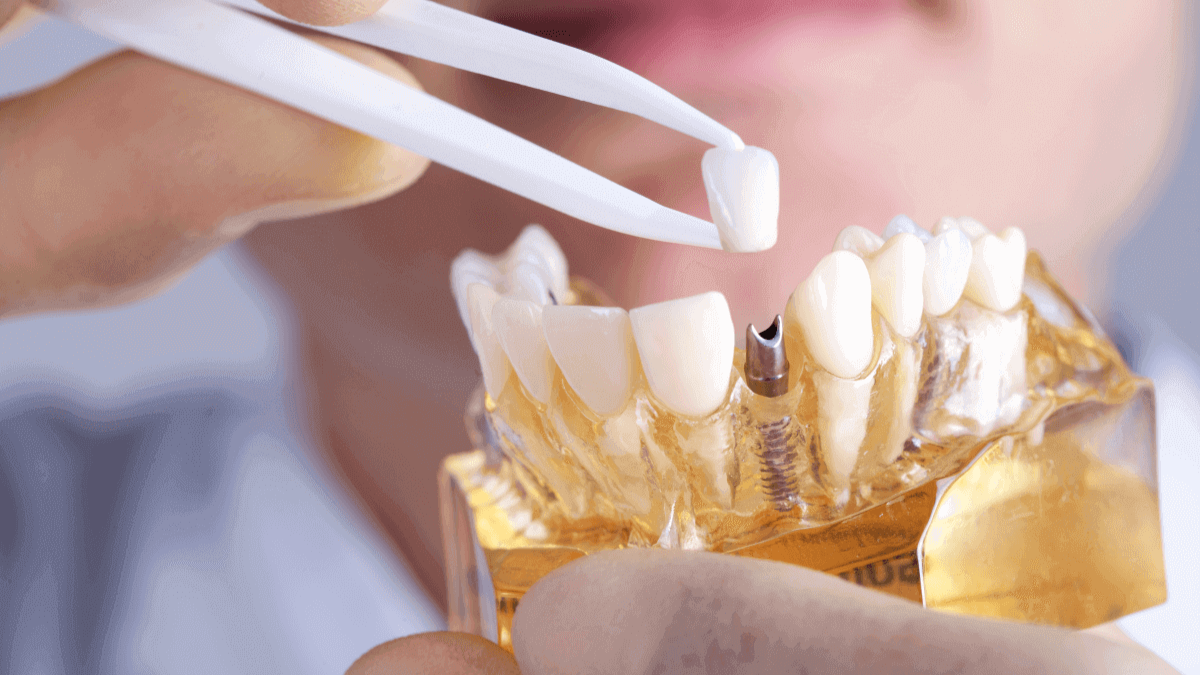 Discover the Benefits of Implant Dentistry in Fort Worth The Ultimate Guide