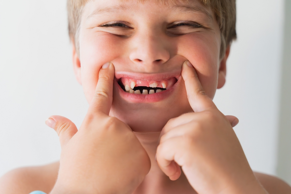 Dental X-ray showing missing teeth, illustrating hypodontia for Jonathan Alexander Abt article